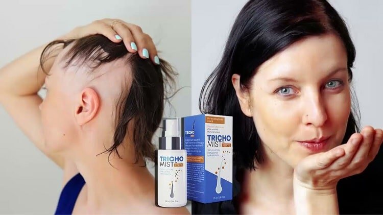 Odkryj Własne Przezwyciężenie Problemów Włosów z Trichomist Forte